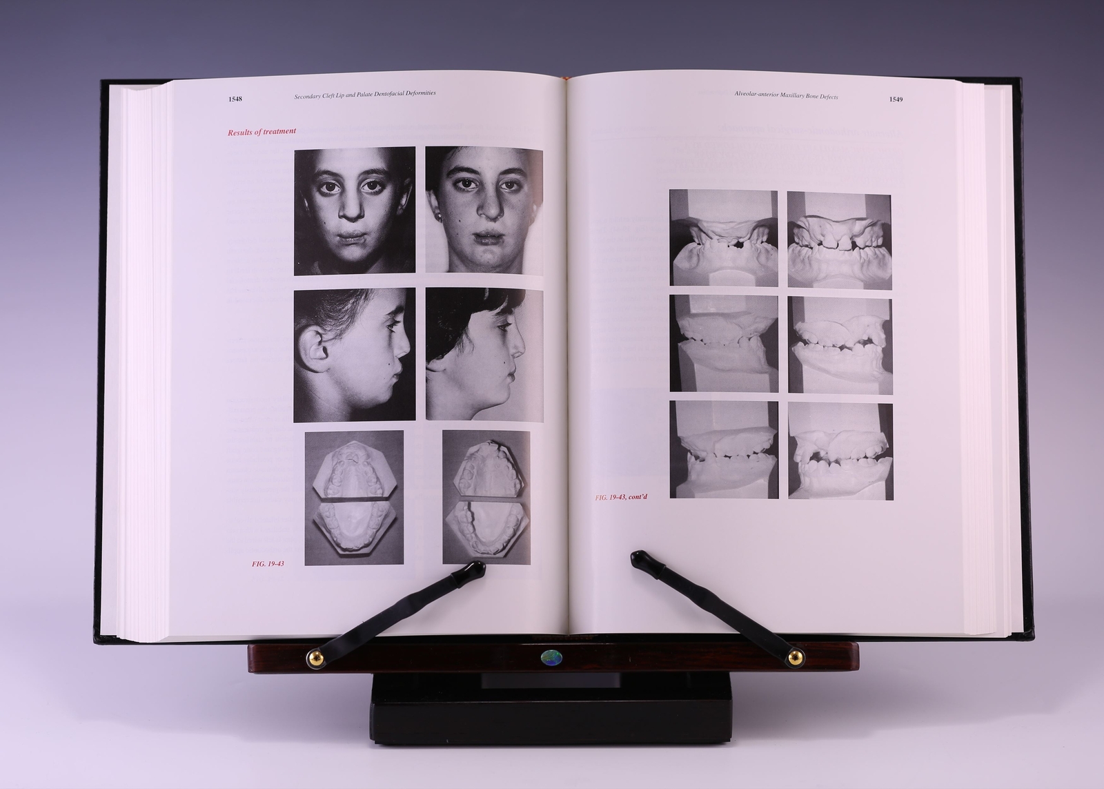 Dentofacial Deformities: Volume III; 2nd Ed by Bruce N. Epker DDS PhD, et al.