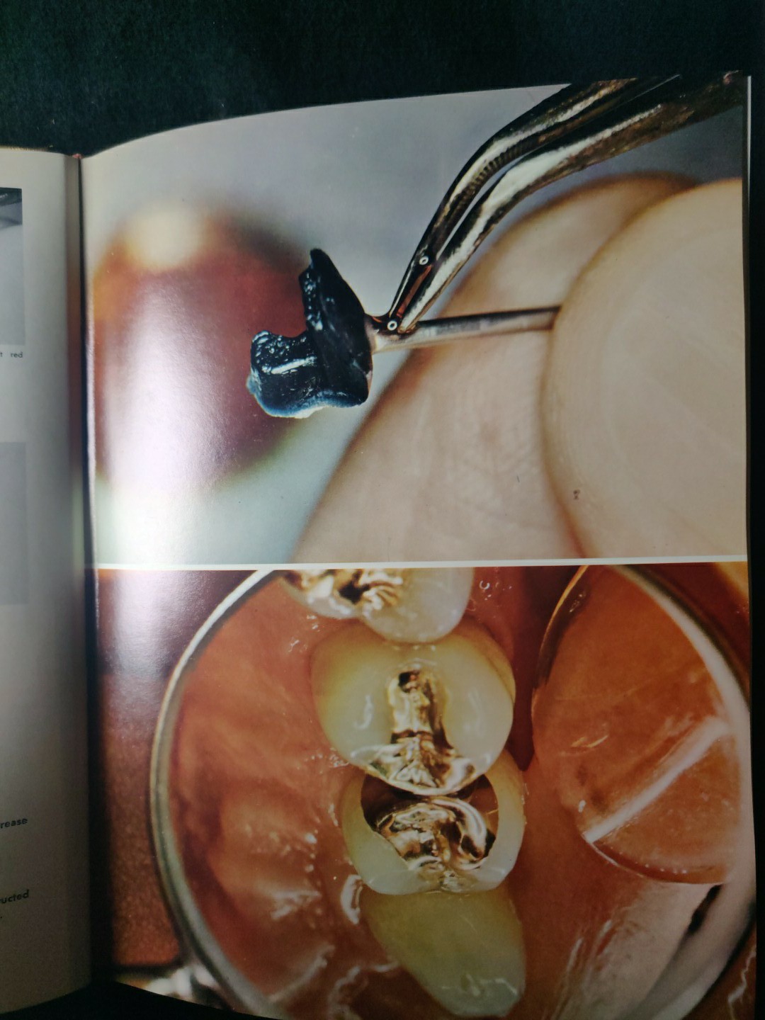 An Atlas of Cast Gold Procedures 1969 Revision Operative Atlas II Dentistry