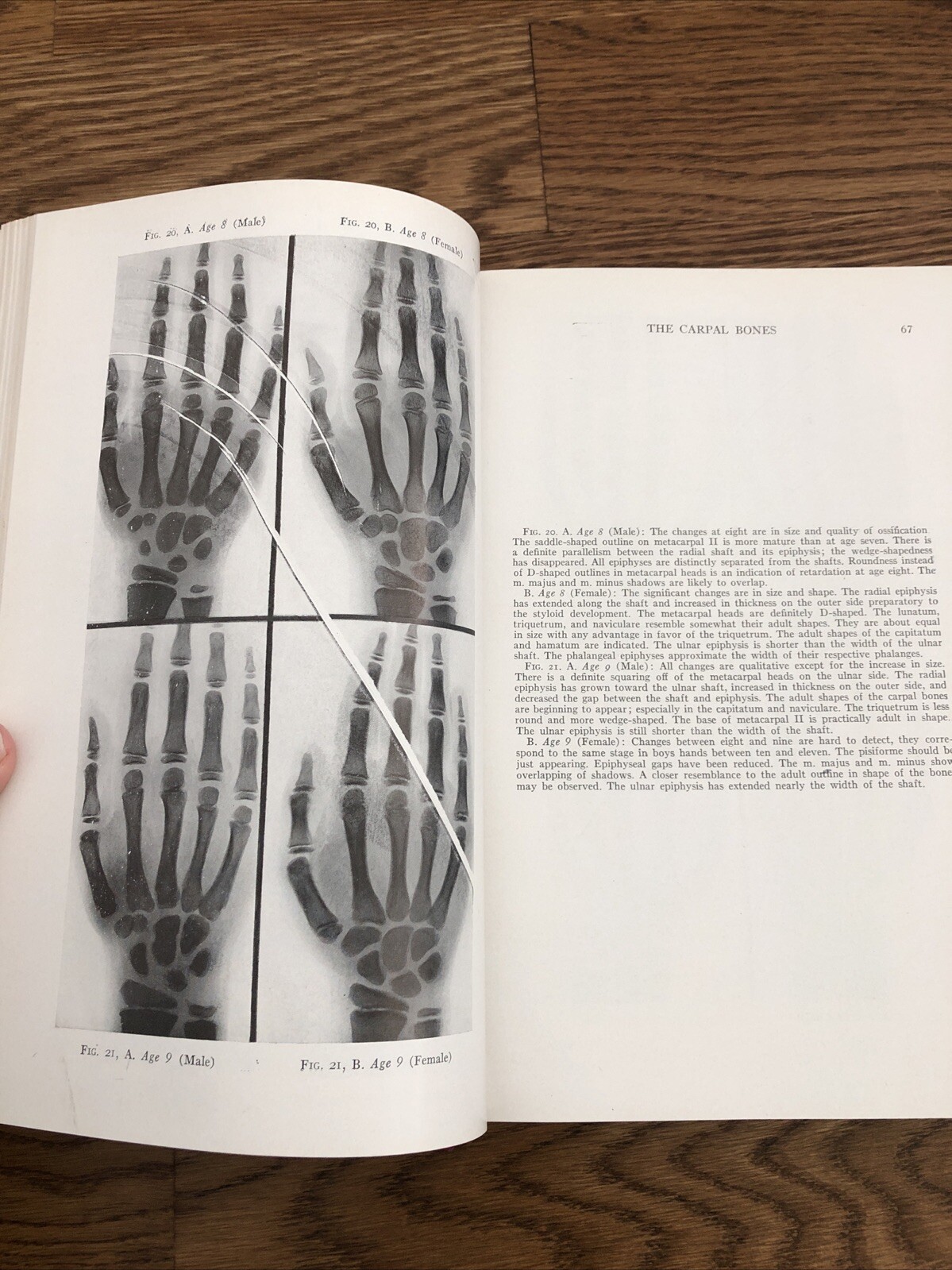 Principles of Orthodontics Salzmann DDS 1943 Illustrated Charts Dentistry HC